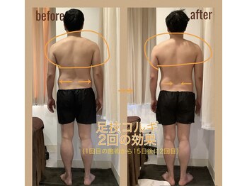 レアフィート(Rheafeet)/症例写真です。