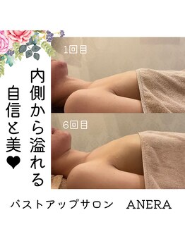 アネラ(ANERA) 心斎橋/20代バストアップビフォアフ症例