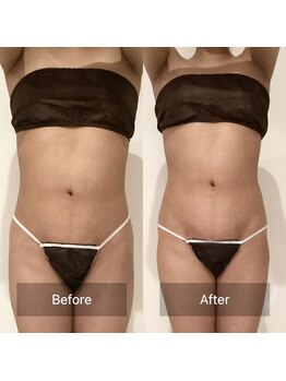 アラマンダ(Allamanda)/腹部BeforeAfter