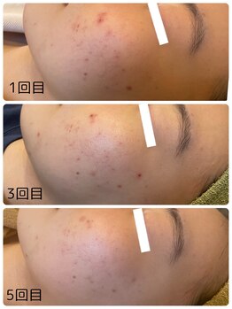 エスポワ/プラズマミストニキビケア