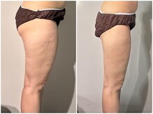 OBS/脂肪冷却プログラム×体重減少