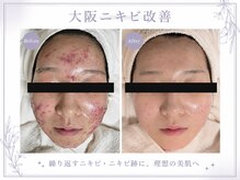 レゾン 京橋店の雰囲気（《完全個室で施術》当店一番人気のニキビケアコースで透明感UP！）