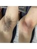 メンズ脱毛シェービング不要のワックス＋光脱毛！　ワキ