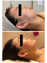 エイシスグロウ(asis glow.)/効果写真