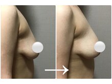 Ms.やまとなでしこ 明石店/バストアップビフォーアフター1