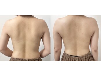 アウラ(Aula)/背中の凝り、めぐる