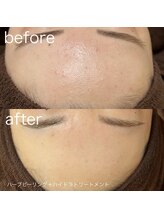 ルルラ リコ(lulula rico)/症例写真/ハーブピーリング