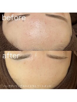 ルルラ リコ(lulula rico)/症例写真/ハーブピーリング