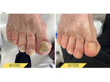 ふっとけ庵/肥厚爪ケア