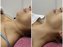 GRACETHOUSAND(グレイスサウザンド)/首のシワに/ハーブピーリング