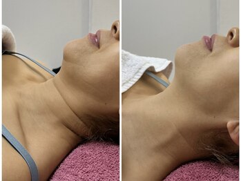 GRACETHOUSAND(グレイスサウザンド)/首のシワに/ハーブピーリング