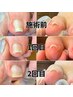 フット巻き爪ケア　２回目以降　1本￥3,300～￥6,600
