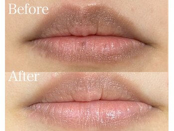 ライム 大宮(LIME)/ローマピンク｜黒ずみケア