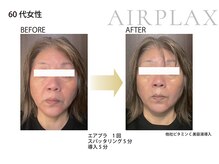 ファロンビューティー(fallon beauty)/プラズマフェイシャル♪