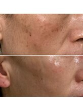 エステルーム アンジュ(Esthe Room Ange)/広がったシ/ADSプログラム半年