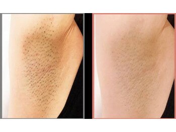 サロン ド エム(Salon du Em)/脱毛