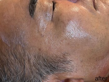 サロン ド エメ(salon de aimer)/【After】シワシミくすみ一掃!