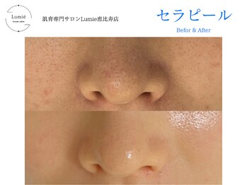 ルミエ 恵比寿店(Lumie)/【韓国式肌管理】セラピール