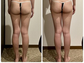 エステティックサロン アンジュ(Ange)/内もも・美尻・ヒップアップへ