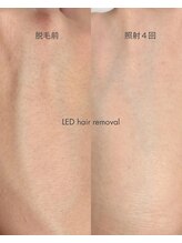 スキンラウンジ(SKIN LOUNGE)/圧倒的効果｜LED脱毛