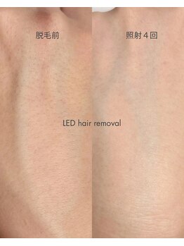 スキンラウンジ(SKIN LOUNGE)/圧倒的効果｜LED脱毛