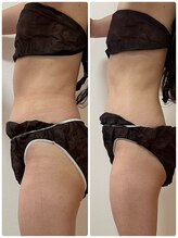 サロン アンネ(Anne)/痩身お腹40分の施術結果