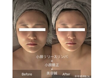 CLERA 恵比寿｜鍼灸院【小顔/リフトアップ/たるみ/エラ張り/毛穴】の写真/エラ張り・歪み改善に！人気No.1コース『エステ×美容鍼』で最強小顔ケア♪