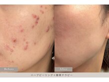 ミランジュ 新瑞橋(miranju)/ニキビ肌に◎ハーブピーリング