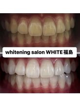 ホワイトニングサロン ホワイト(WHITE)/セルフホワイトニング効果