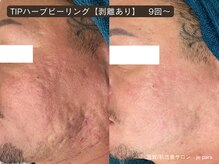 ジュパール(je pars)/TIPハーブピーリング剥離あり