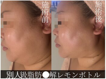 ハイフン(HIFUN)/【小顔別人級】レモンボトル