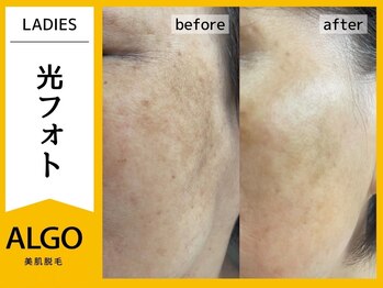 アルゴ 小松店(ALGO)/光フォト（50代女性）