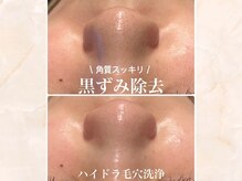 シャングリラ(Shangri-La)/ハイドラ毛穴洗浄