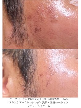 デコアイ(Deco eye)/50代男性 シミ