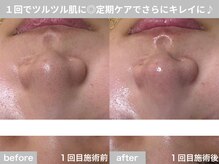 サロン ビュー(salon view)/30代女性〈毛穴黒ずみ悩み〉