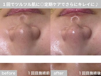 サロン ビュー(salon view)/30代女性〈毛穴黒ずみ悩み〉