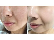 リボーン(REBORN)/幹細胞フェイシャルがおすすめ