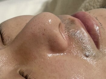 キアラ(CHIARA)の写真/《毛穴汚れごっそり！》毛穴の黒ずみ・汚れが詰まりやすい男性に人気◎気になるお悩みお任せください！