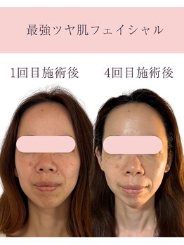 シンナリ(Shinnari)/最強ツヤ肌フェイシャル