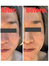 シェノン(Chainon)/フェイシャルハーブピーリング