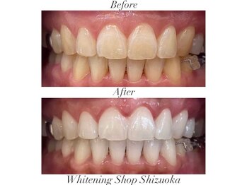 ホワイトニングショップ 静岡店/ホワイトニングBefore→After