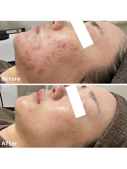 ニキビケア研究所 高崎店の写真/年間8000名の実績『ニキビ・肌荒れ専門サロン』！繰り返すトラブルの原因がわかる！肌診断＋当日施術相談◎