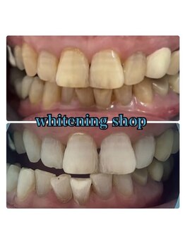 ホワイトニングショップ 池田店/【BEFORE/AFTER】