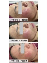 パルティール(PARTIR)/REDショット】小顔ツヤ張り美肌