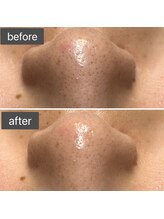 ロッタ エクリュ(Lotta ecru+)/REVI剥けないハーブピーリング