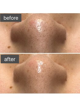 ロッタ エクリュ(Lotta ecru+)/REVI剥けないハーブピーリング