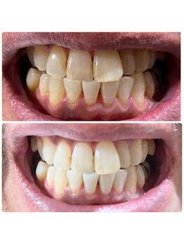 ワイズサロン(Y's salon)/ホワイトニング５回終了！