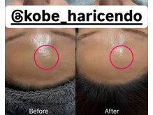 ハリシェンド/WiQOピール