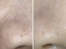 コハク(kohaku)/毛穴の黒詰りを洗浄吸引後エレポ