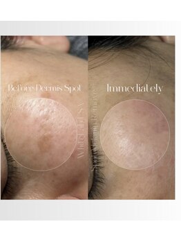 ルミラポー(Lumira Peau)/シミ集中ケア